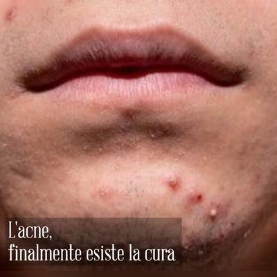 Finalmente trovata la cura dell'acne